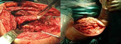 pseudoartrosis, grave atrofia ósea. A la derecha, preparando el aloinjerto estructural.