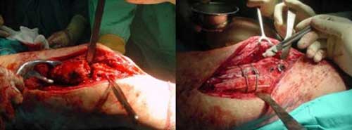 Cirugía abierta con Injertos-y-Sustitutos-Óseos-en-Prótesis-de-Cadera-y-Rodilla