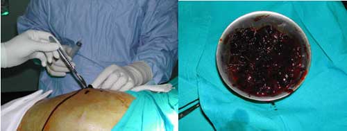 Evacuación de hematoma tras prótesis de cadera con persistencia de manchado.