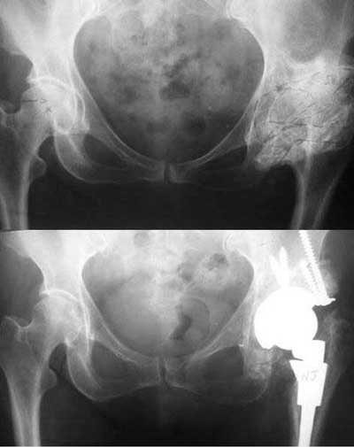 paciente operada de desartrodesis de cadera. Radiografía de caso real