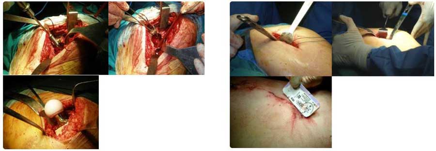 Comparación entre abordaje convencional vs. cirugía mínimamente invasiva: MIS de cadera.