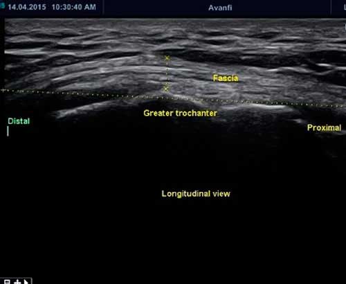 ecografía de paciente con distorsión de estructuras y engrosamiento de la fascia en un caso de cadera en resorte.