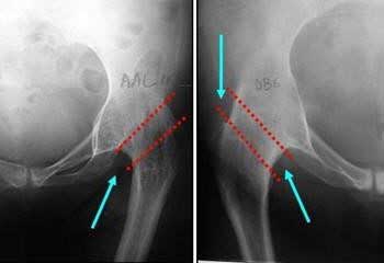 radiografía-de-preparación-de-cirugía-de-desartrodesis-de-cadera