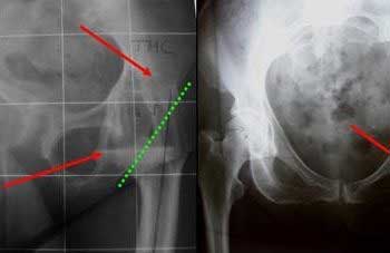 radiografía-de-preparación-de-cirugía-de-desartrodesis-de-cadera