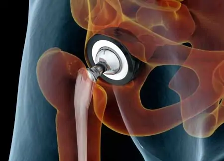 Operación de prótesis de cadera para reemplazar la articulación de la cadera