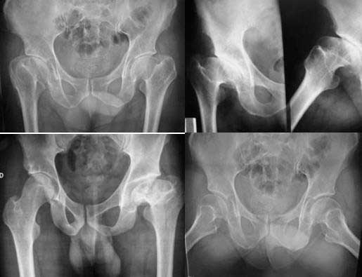 Radiografía de paciente con dolor de cadera por cadera displásica