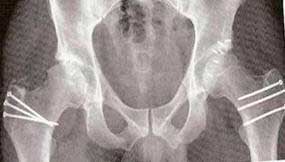 Osteoplastia-para-tratar y corregir el-atrapamiento-Femoroacetabular
