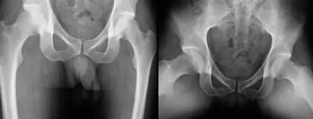 Radiografía-de-prótesis-de-cadera-dolorosa en un paciente joven