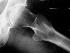 Radiografía-de-un adulto joven con cadera-dolorosa