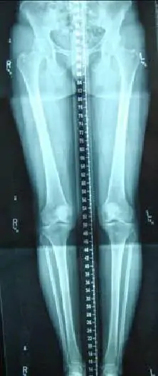 Radiografía de diagnóstico de la rodilla del corredor