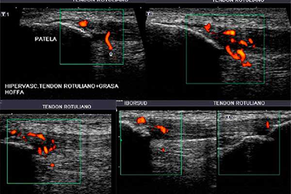 Imagen ecográfica del tendón rotuliano para diagnosticar la tendinopatía o rodilla del saltador
