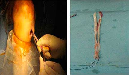 cirugía-del-ligamento-cruzado-anterior-de-la-rodilla
