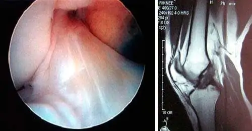 diagnóstico de la rotura del-ligamento-cruzado anterior de la rodilla