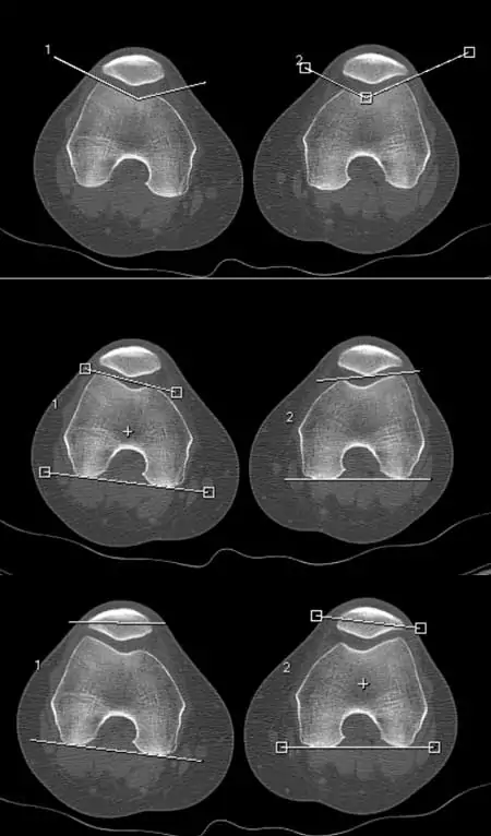imágenes de TAC dinámico para el diagnóstico de la condromalacia rotuliana