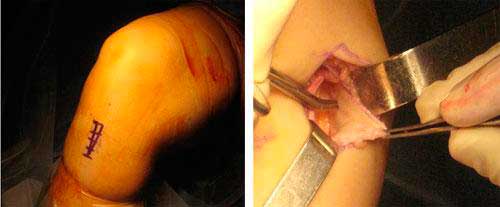 operación-del-ligamento-cruzado-anterior-de-la-rodilla