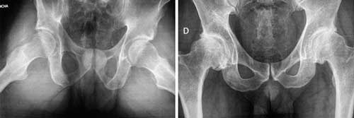 radiografía-de-cadera-con-pubalgia