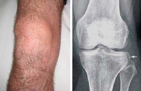 radiografía-de-paciente-con-rotura-de-ligamento-cruzado-anterior-de-la-rodilla