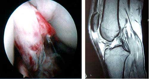 resonancia-magnética-del-ligamento-cruzado-anterior-de-la-rodilla