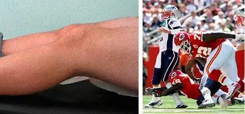 rotura del ligamento cruzado anterior de la rodilla