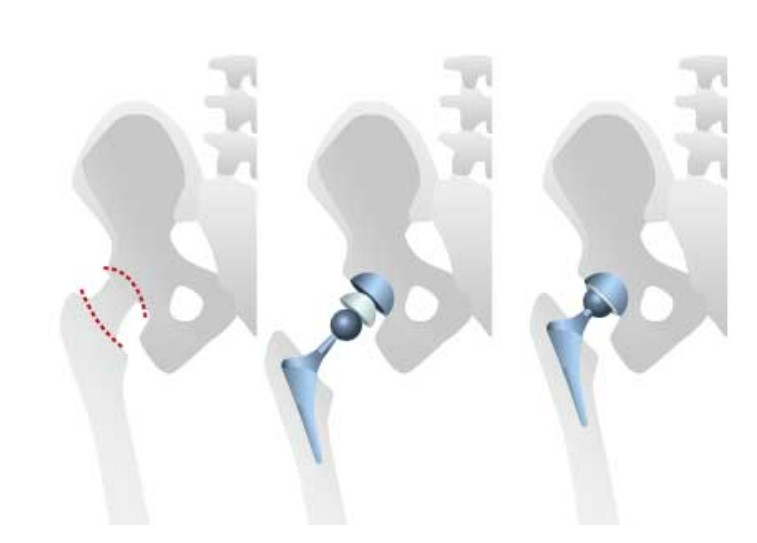 Desgaste y recambio de la prótesis de cadera
