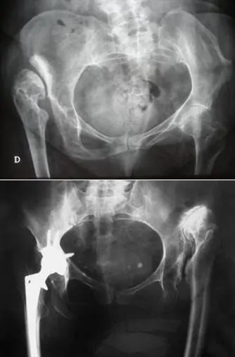 radiografía de paciente de 29 años con displasia de cadera