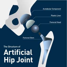 Estructura y componentes de una cadera artificial