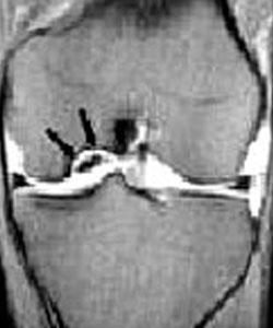 Osteonecrosis de la rodilla o necrosis avascular de rodilla. Lesiones osteocondrales en la rodilla