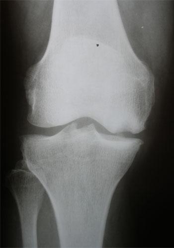 Osteocondrítis del cóndilo femoral interno en paciente joven. Osteonecrosis de la rodilla