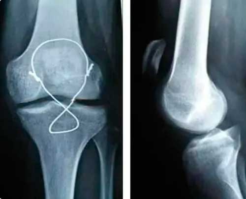 Radiografía de cerclaje transóseo de descarga en el tratamiento de la rotura del tendón rotuliano