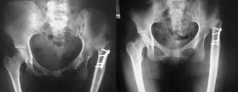 deformidad bilateral y displasia tipo IV de la cadera izquierda