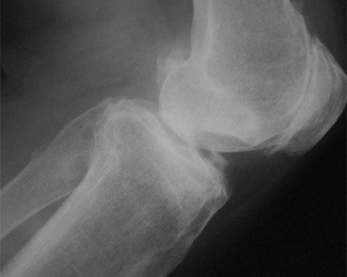 lesiones osteocondrales de rodilla. Necrosis avascular de rodilla