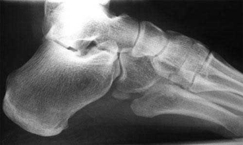 Hueso subastragalino del tobillo con artrosis