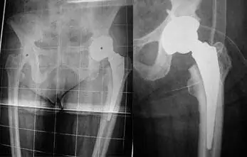 radiografía de una prótesis de cadera