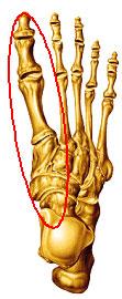 Anatomía de un pie con Hallux Rígidus