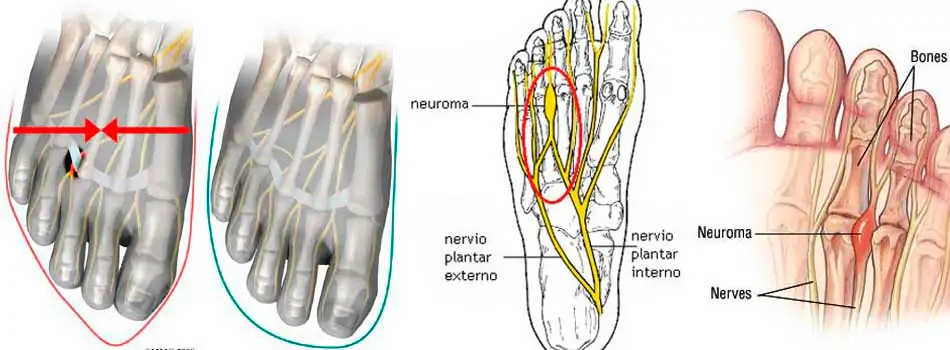Anatomía del neuroma de Morton