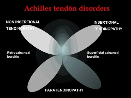 Tendinosis y Tendinitis Aquilea