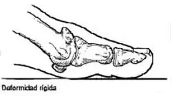 Pie con deformidad de Hallux rígidux Pie con deformidad de Hallux rígidux