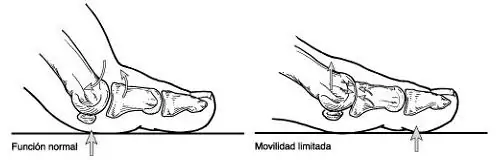 Qué es el Hallux rígidus Qué es el Hallux rígidus