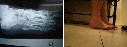 Radiografía de un pie con Hallux Rígidus