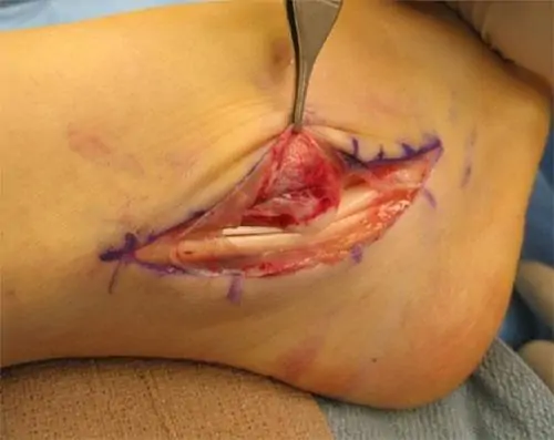 Tratar con cirugía las lesiones de los tendones peroneos