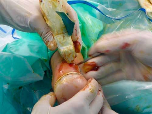 cirugía ecoguiada ultramínimamente invasiva de la enfermedad de Haglund-