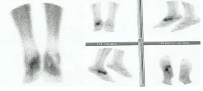 gammagrafía en la lesión de la articulación de Lisfranc