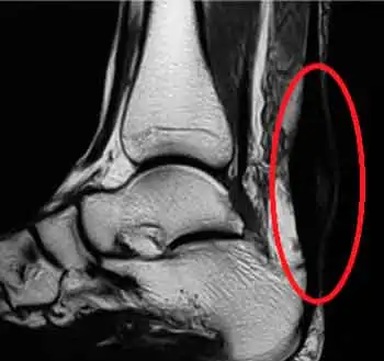 resonancia magnética de tendinitis de Aquiles resonancia magnética de tendinitis de Aquiles