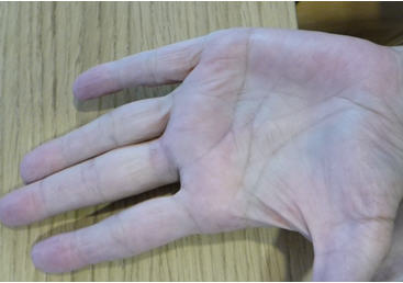 Cirugia Ecoguiada de los dedos de la mano en resorte