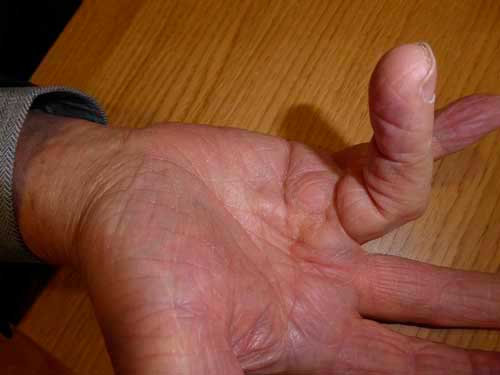 Dupuytren o retracción de los dedos de la mano