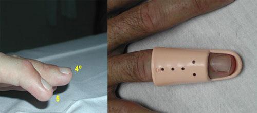 Férula de Stack por lesión cerrada del extensor largo de la mano