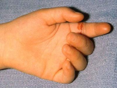 Lesión de los tendones flexores de la mano