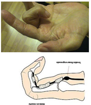 dedo en resorte o tenosivitis estenosante de los dedos de la mano