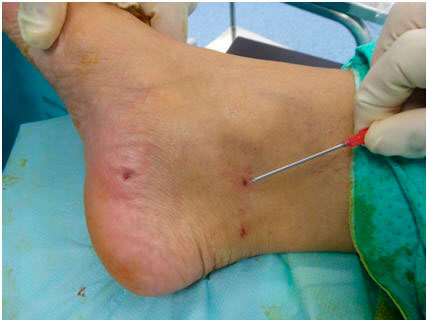 cicatriz de operación del síndrome del túnel tarsiano con cirugía ecoguiada