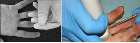 tratamiento de los dedos en resorte o tenosivitis estenosante de los dedos de la mano